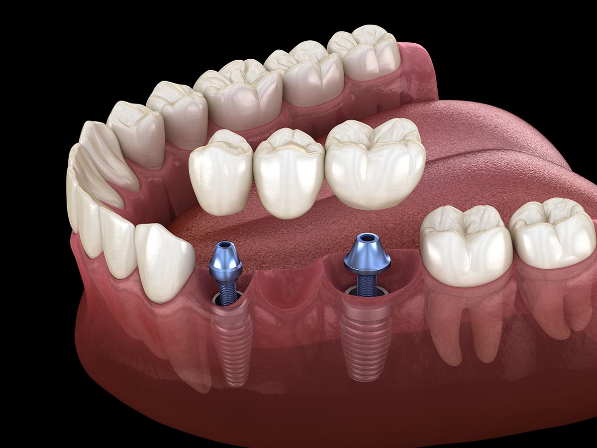 Implant Supported Bridge