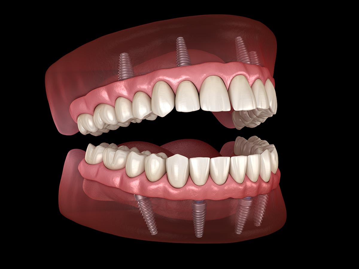 Implant Supported Dentures