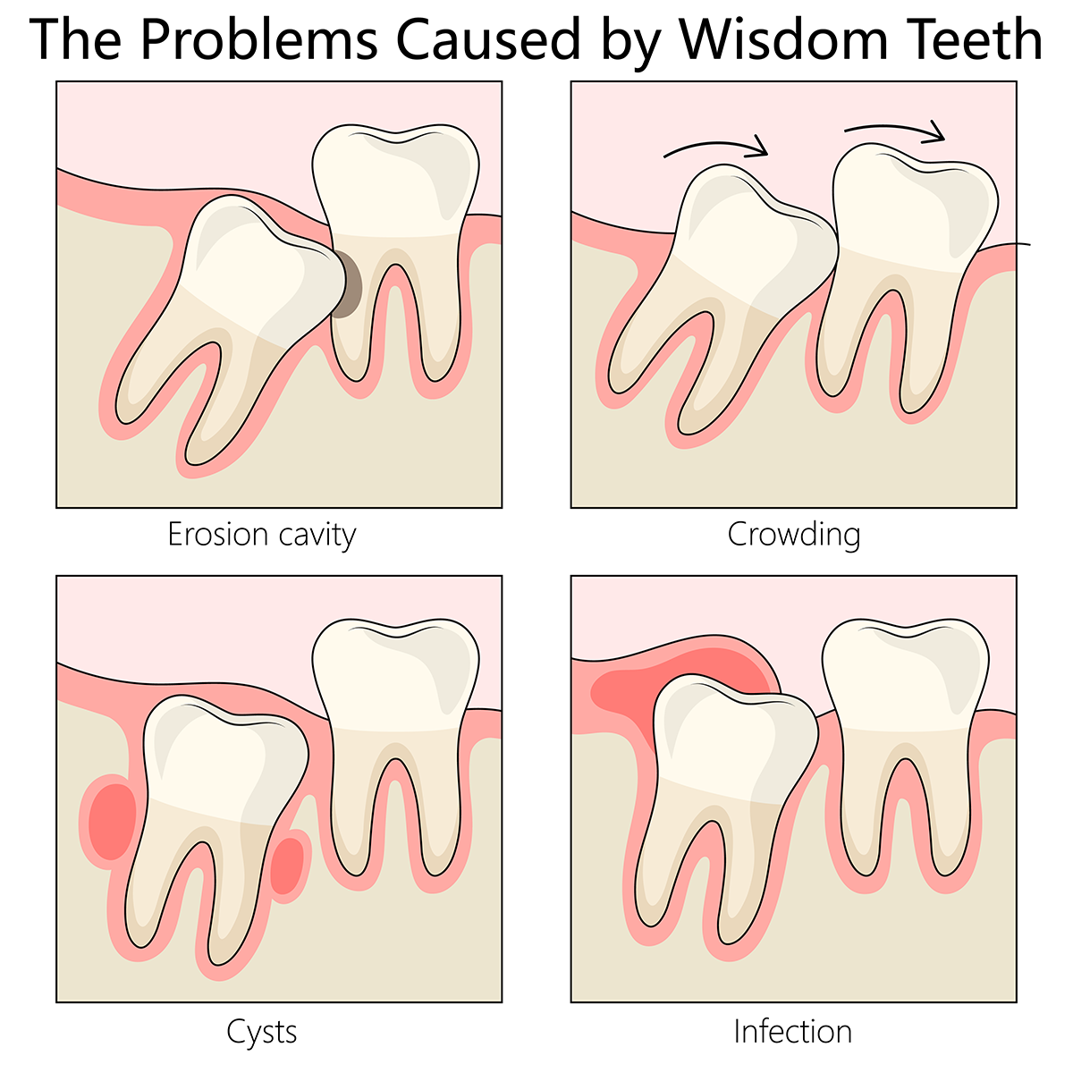 Wisdom teeth problems