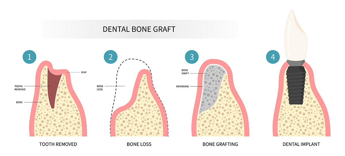 bone graft - teal