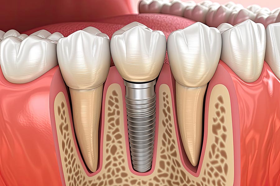 3D render of a dental implant being installed into a model of the gum