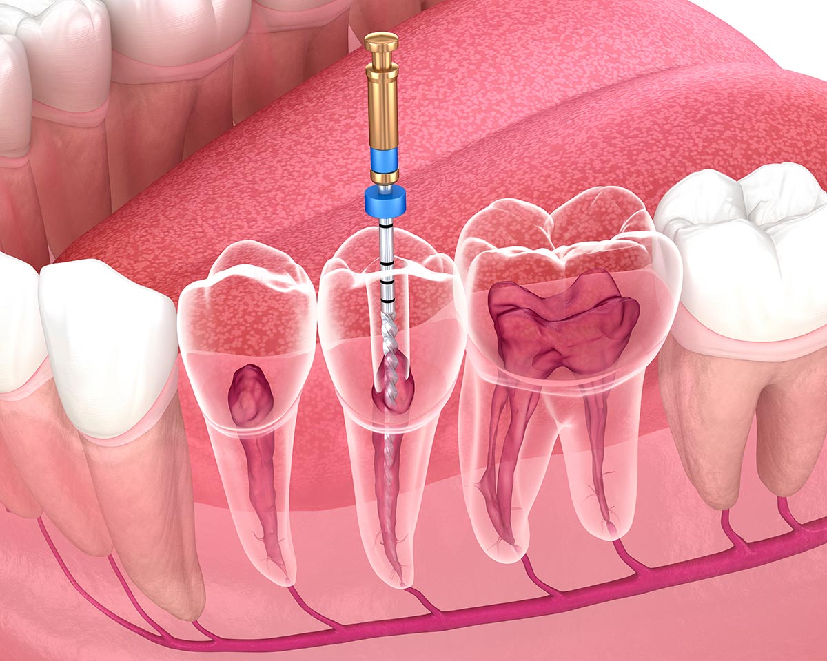 Endodontic root canal treatment process. Medically accurate tooth 3D illustration.