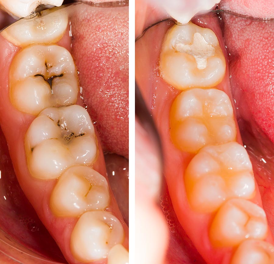 Before and after dental treatment - beforeafter series.